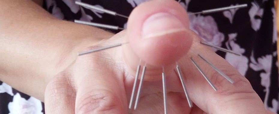 Akupunktura w Medi Raju. Fachowcy ze Wschodu!