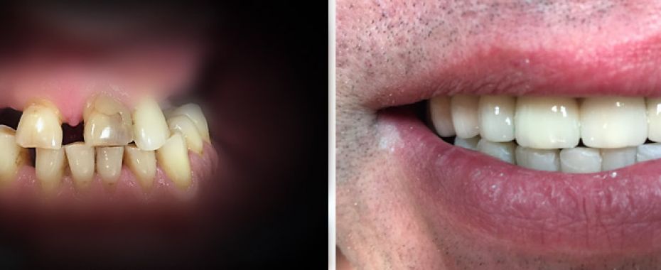 Implanty zębów Szczecin - jak wygląda zabieg montażu implantów?